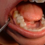 Amalgams After Removal and Replaced with Composite 2