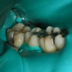 Amalgams Following Safe Removal Protocol