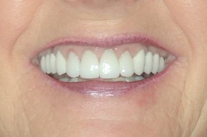 We decided to proceed with 4 porcelain crowns for her front teeth and new bridges for her back teeth. The result was a straighter, whiter smile she cannot hide! She ended up looking 10 years younger!