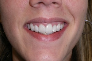 With a combination of 8 porcelain crowns and veneers, we were able to achieve the result she was after - a dazzling straight, white smile!