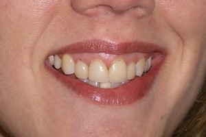 This patient was unhappy with the color and shape of her smile. She wanted whiter, straighter, more dazzling smile.
