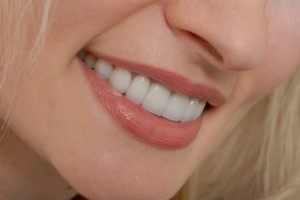 Dental Veneers Shelby Township, Michigan