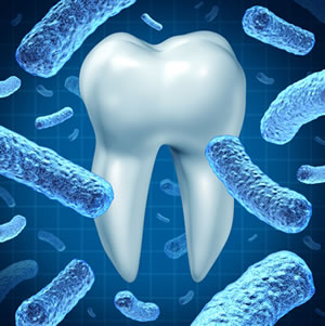 Laser Bacterial Reduction Therapy for Periodontal Disease - Shelby Twp., MI