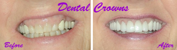 Dental Crown Procedure Explained for Patients - Washington Township