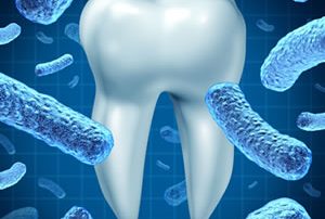 Laser Bacterial Reduction Therapy for Periodontal Disease - Shelby Twp., MI