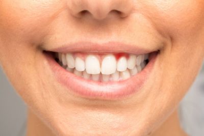 The Importance of Having Healthy Gums