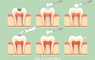 Shelby Twp. Dentist Explains Composite Resins