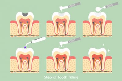 Shelby Twp. Dentist Explains Composite Resins