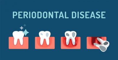 What Is Periodontitis?