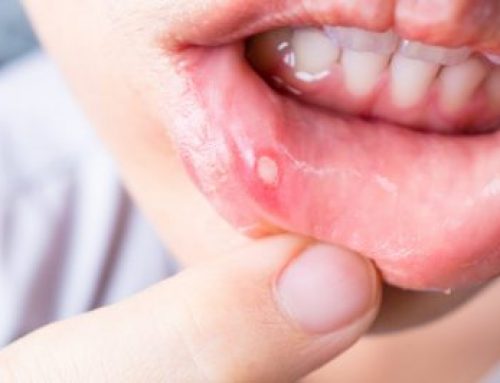 Conditions That Are Strikingly Similar To Canker Sores!