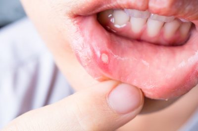 Conditions That Are Strikingly Similar To Canker Sores