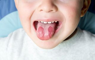 All You Need To Know About Geographic Tongue!
