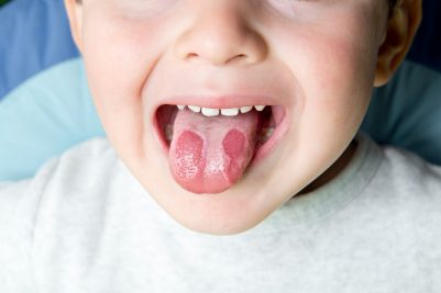 All You Need To Know About Geographic Tongue!