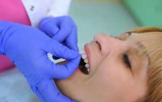 All You Need To Know About Dental Veneers