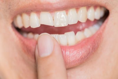 Dental Fractures: Types, Symptoms And Treatment Options
