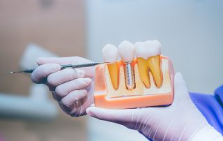All You Need To Know About Dental Implants
