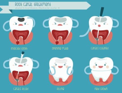 Root Canal Treatment in Shelby Township, Michigan 