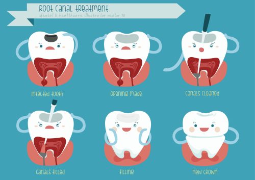 Root Canal Treatment - Shelby Township