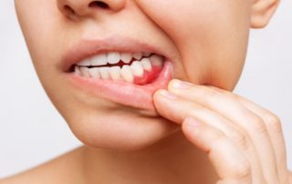 Common Signs of Gum Disease and How to Treat It