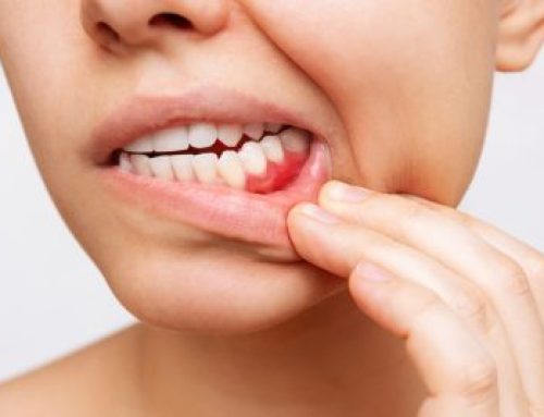 Common Signs of Gum Disease and How to Treat It