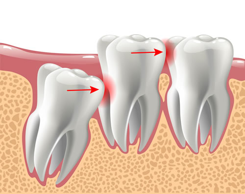 wisdom teeth stitches fall out