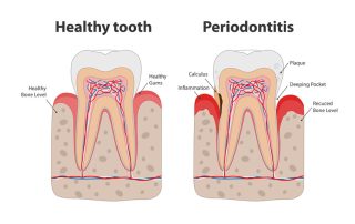Gum Disease - Periodontitis