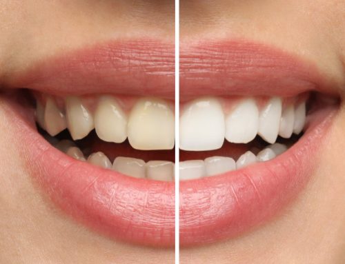 Achieving Dazzling Smiles with ZOOM!® AP Whitening at HPS Advanced Dental