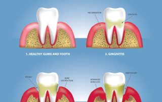 Gum Disease - Periodontal Disease