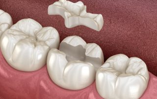 Dental Inlay - Tooth Restoration Shelby Twp Michigan